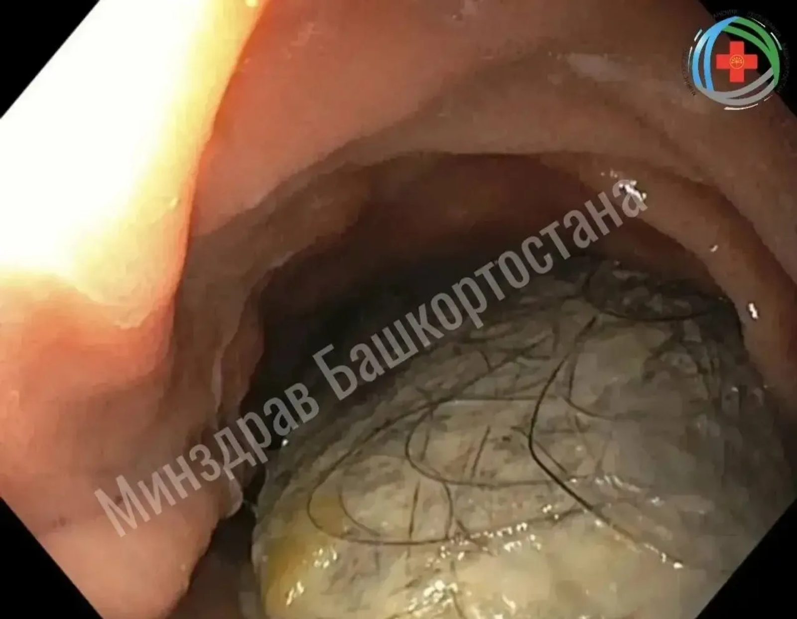 Бирән ҡорһаҡ ошолай була