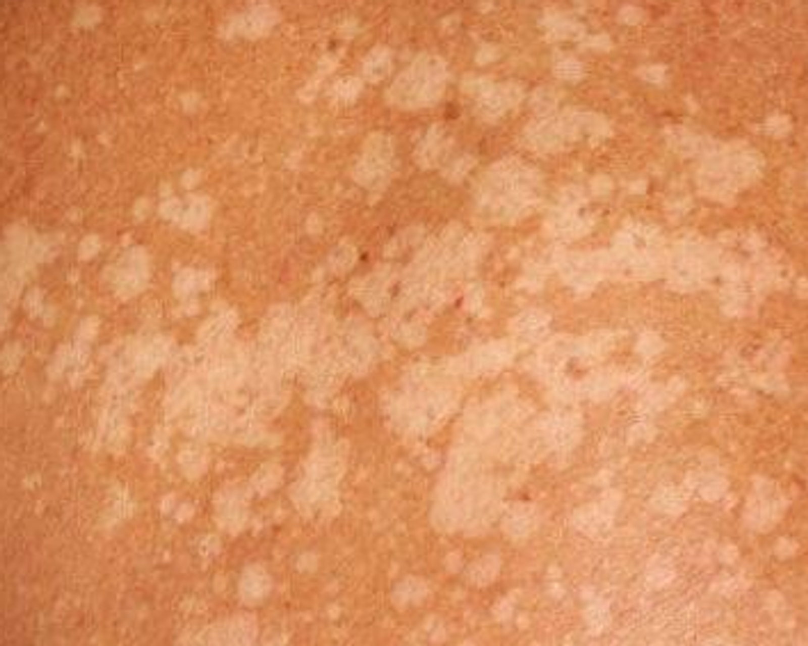 Тимрәүҙе нисек дауаларға?